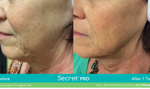 Facial Skin Tightening Before After Mississauga Oakville